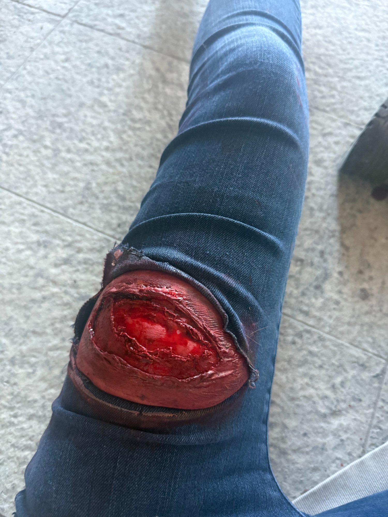 Simulated below-knee amputation moulage