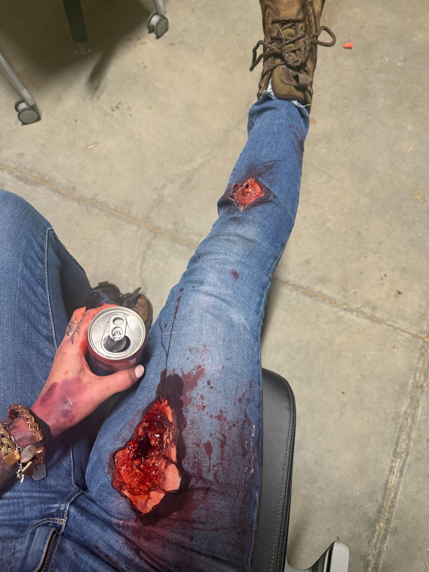 Simulated multiple GSW leg wounds